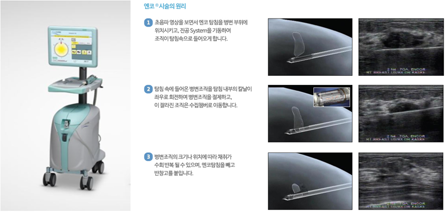 진공보조흡인유방생검술