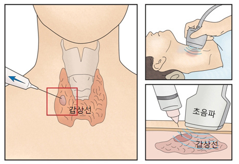 갑상선 결절